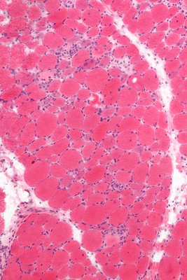 Home Dermatomyositis