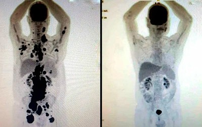 Remissão de câncer com terapia celular CAR-T Cell